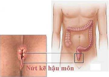 NỨT KẼ HẬU MÔN: NGUYÊN NHÂN, CHẨN ĐOÁN VÀ CÁCH ĐIỀU TRỊ, PHÒNG TRÁNH